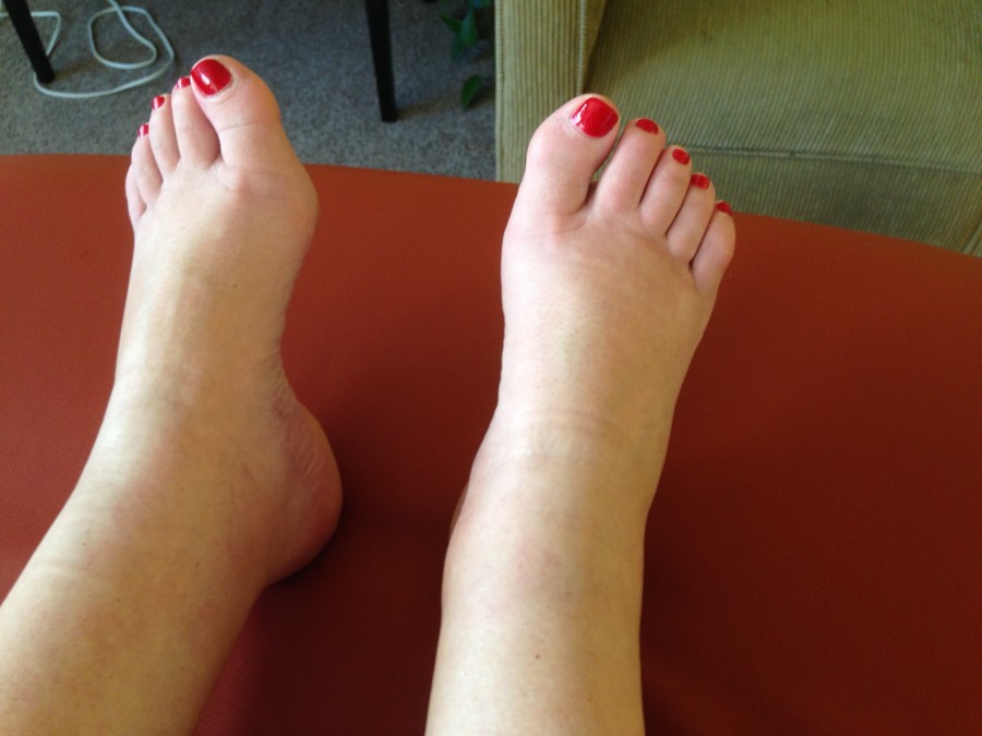 ms-and-swollen-feet-causes-symptoms-and-treatment